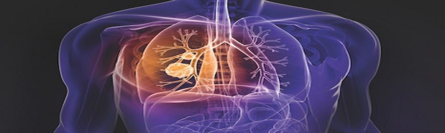 Non-Small Cell Lung Cancer- Healthcare Journal Blog